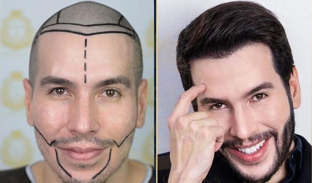Saç Ekiminde Kusursuz Sonuçlar: Hair Center of Turkey