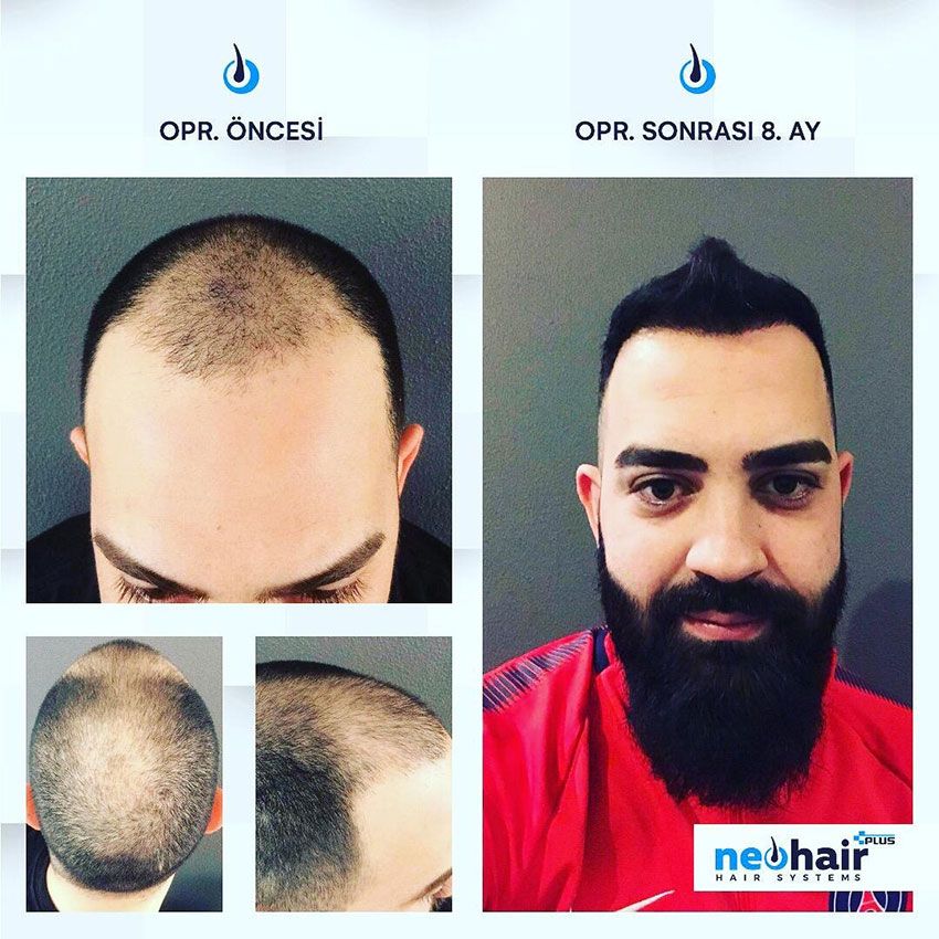 Neo Hair1
